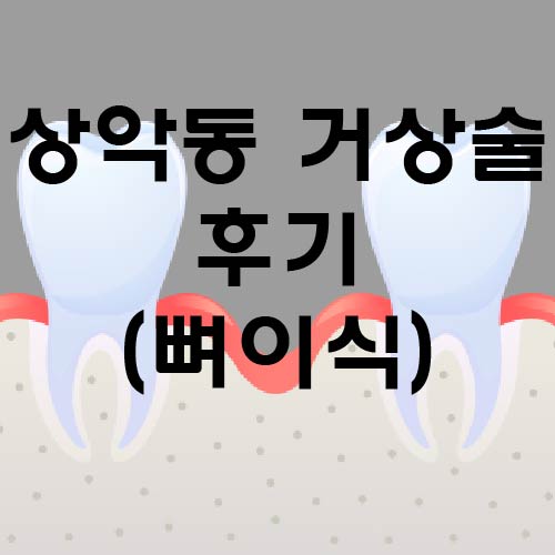 임플란트 뼈이식(상악동 거상술) 직접 받은 후기 feat 가격(비용), 부작용