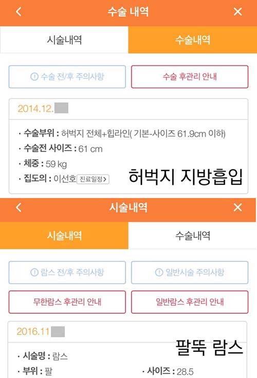 지방흡입과 람스 차이가 뭘까 둘 다 받아본 내돈내산 후기