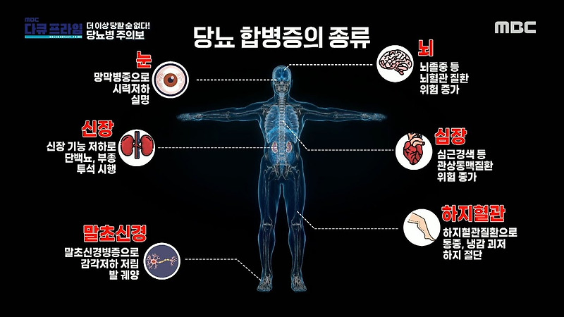 당뇨가 무서운 이유. 합병증!