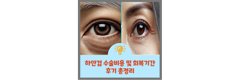 하안검 수술비용 및 회복기간, 후기 총정리