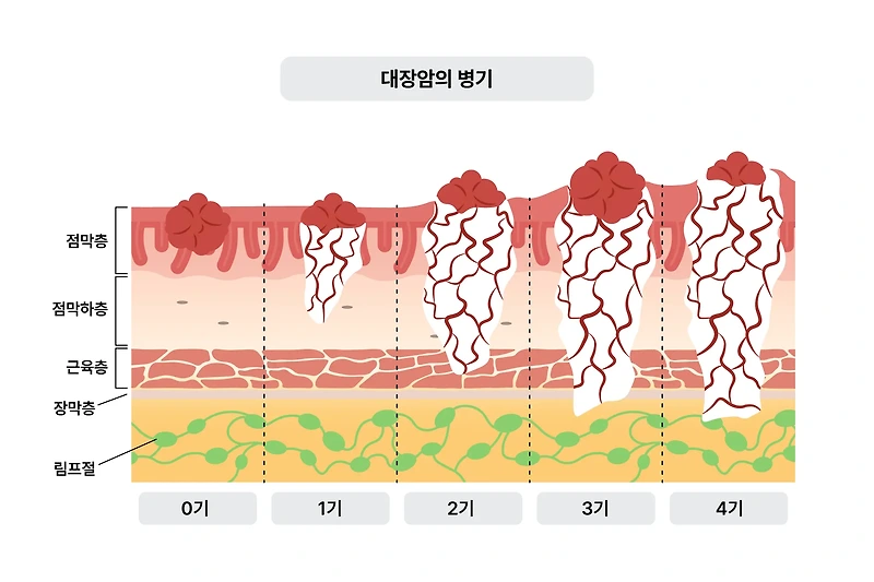 대장암 초기증상 혈변 알아보기