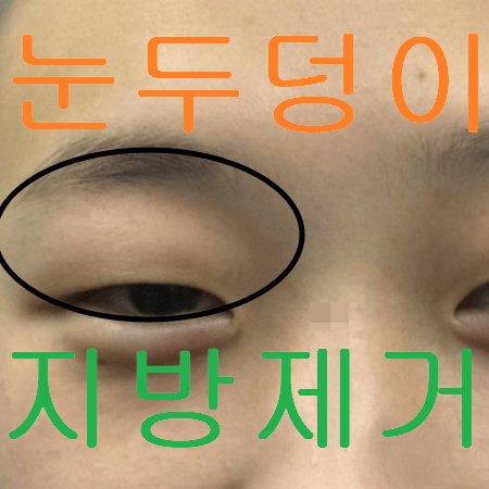 눈두덩이 지방제거 수술 두 가지 ( 지방 종류에 따라 달라짐 )