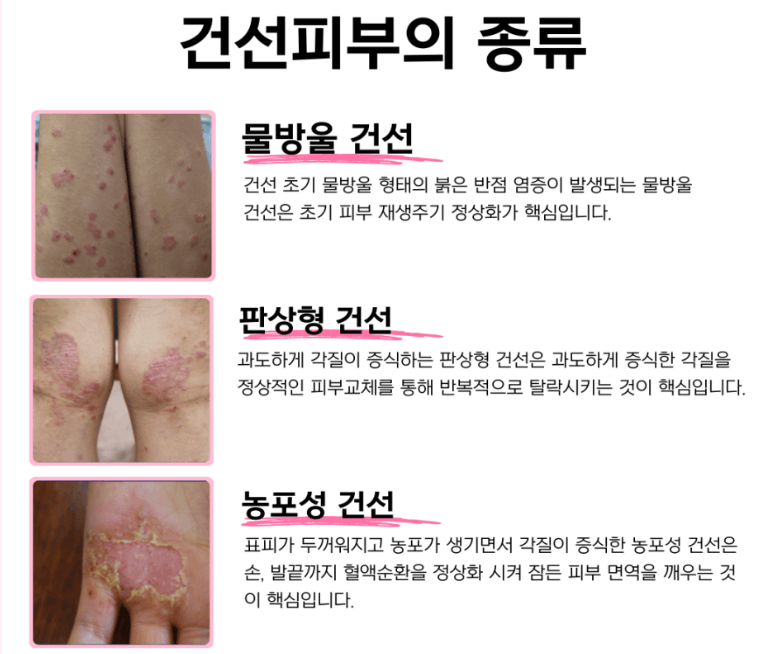 겨울철 찾아오는 피부질환 건선과 피부건조증 차이에 대해 알아보기