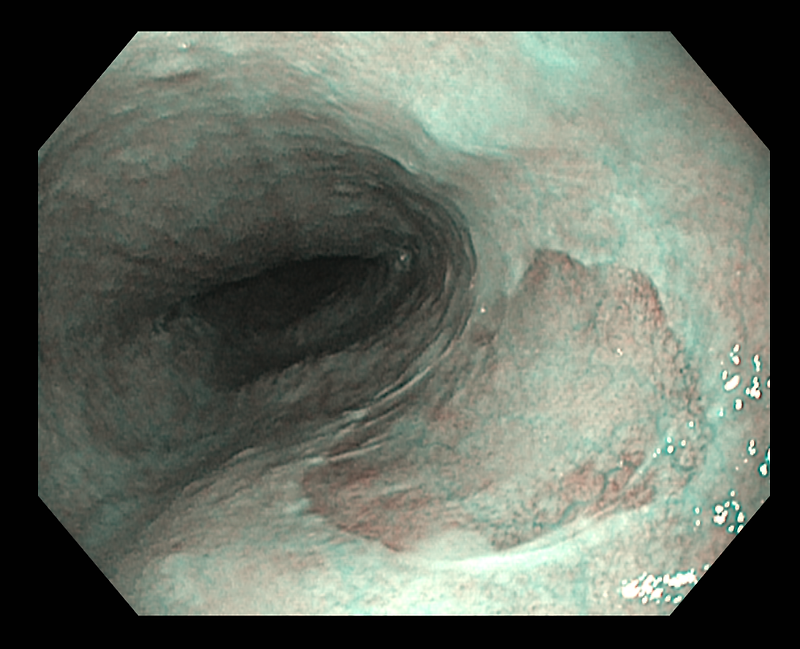Inlet patch, heterotopic gastric mucosa of the upper esophagus [HGMUE]