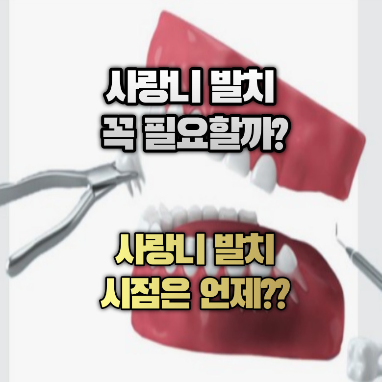 사랑니 발치 꼭 필요할까? 사랑니 발치 시점은 언제?