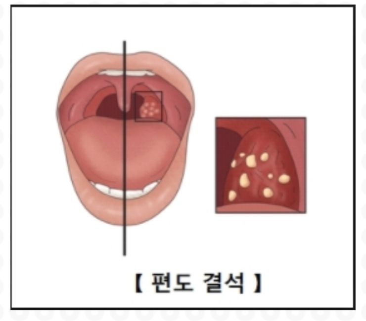 편도결석 원인 편도결석 빼는법까지 한번에 정리해봤어요.