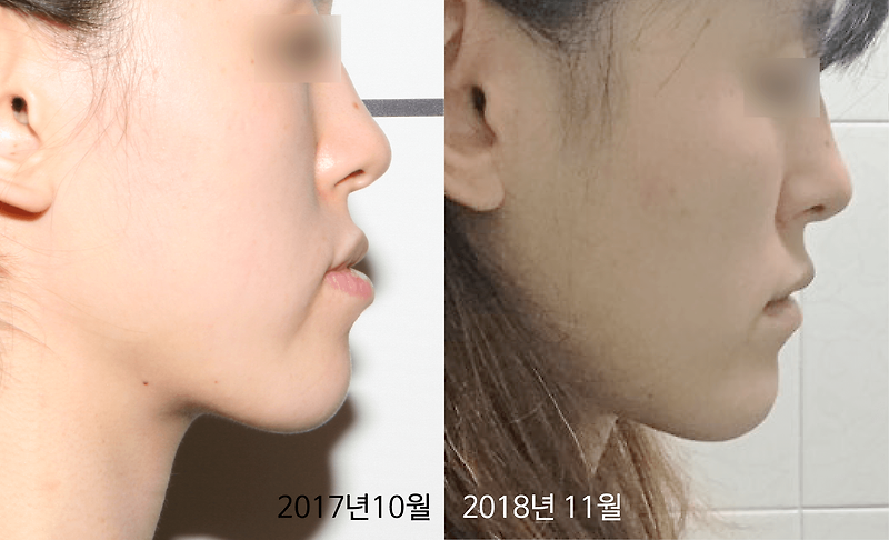 주걱턱 양악 윤곽수술 없이 3배 예뻐지는 방법