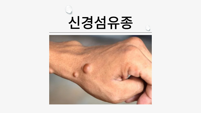 신경섬유종 원인부터 치료, 밀크반점과 차이점