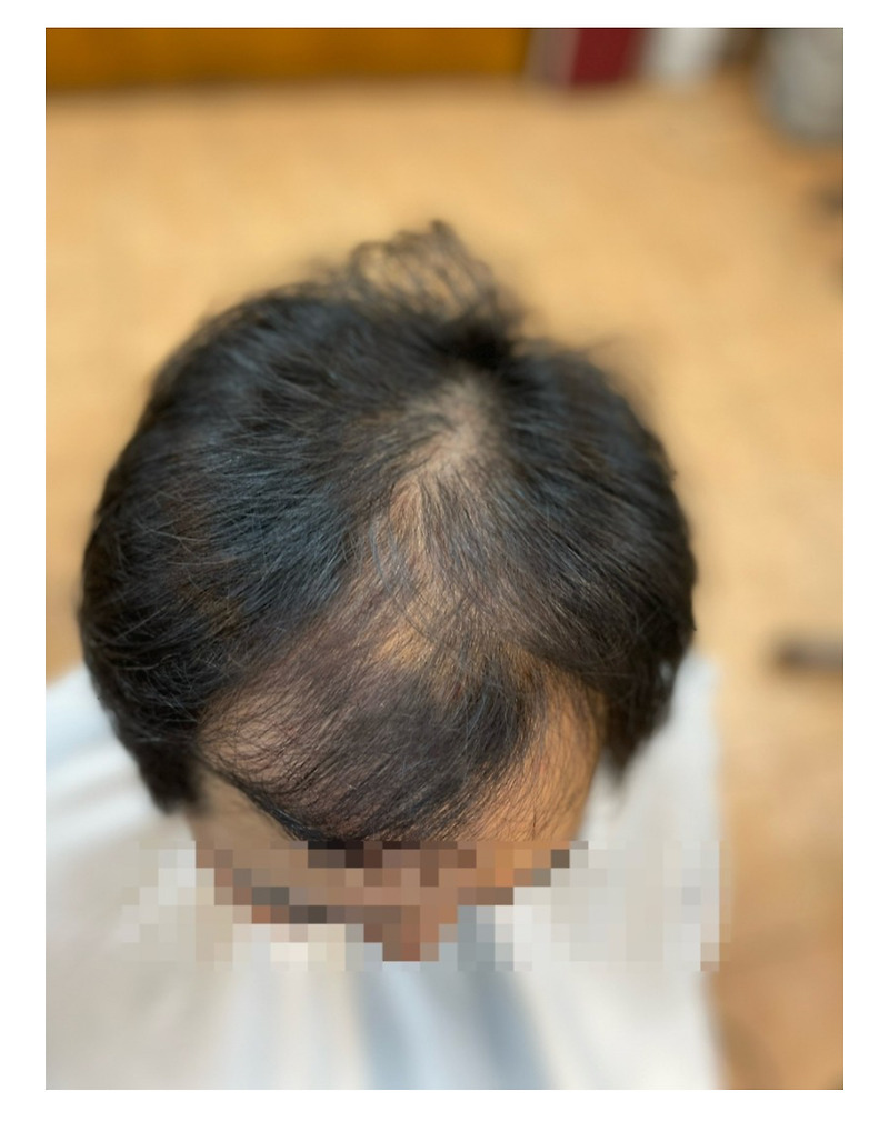 해운대구에서 왔어요 남자탈모성형펌 세젤부탈모펌/부산사상르네시떼헤어 주례감전학장김해당감부전진구전포부전양정범일범천수영망미안락동래미남충렬가야
