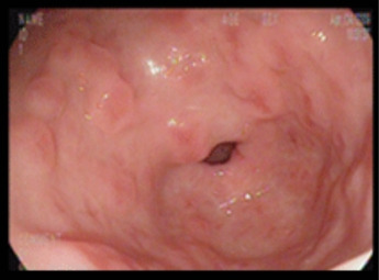 위염 정의 증상 그리고 예방법 스트레스가 주된 원인 ? gastritis