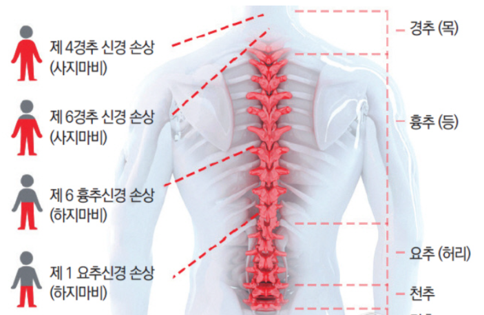 척수 손상 수준별 기능 증상과 합병증 반사평가 ASIA scale, SCIM, FIM