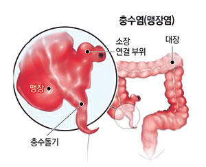 충수돌기염 (맹장염)