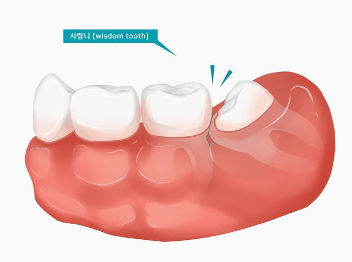 사랑니(매복) 발치 후 관리 방법