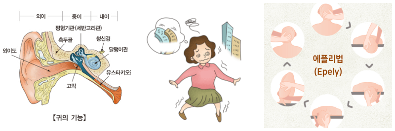 어지러움증을 유발하는 이석증. 원인, 증상, 자가치료 방법(에플리 치료법)