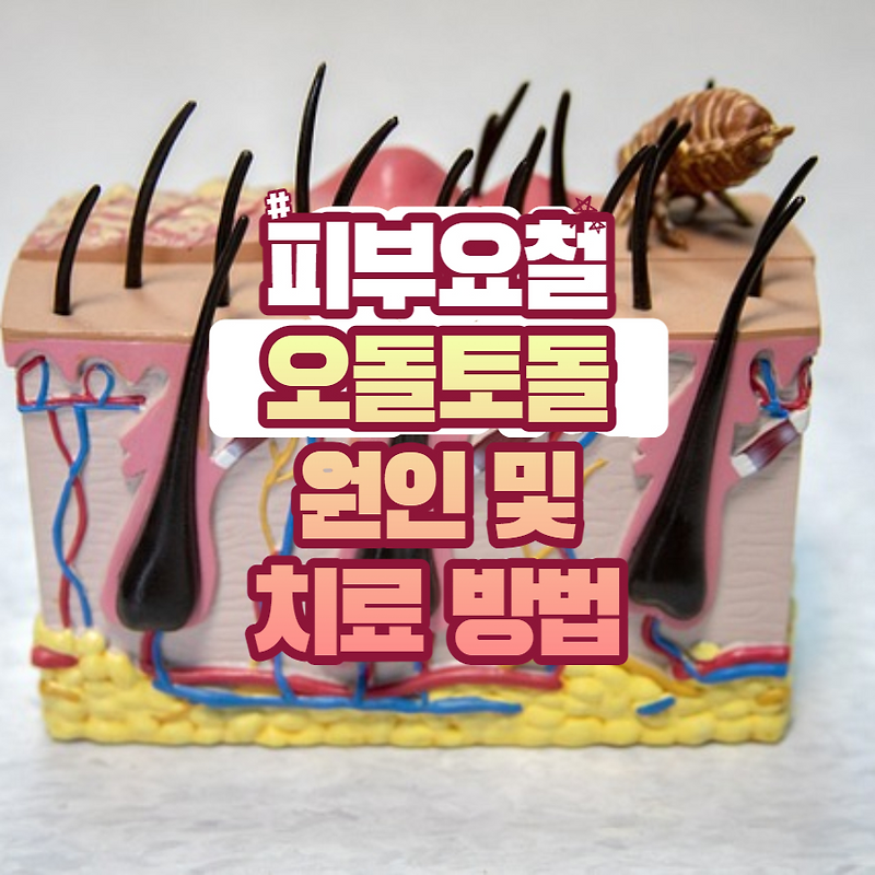 피부요철 오돌토돌 원인 및 치료 방법