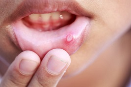 입안 점액낭종(Mucocele) 생기는 이유와 치료법