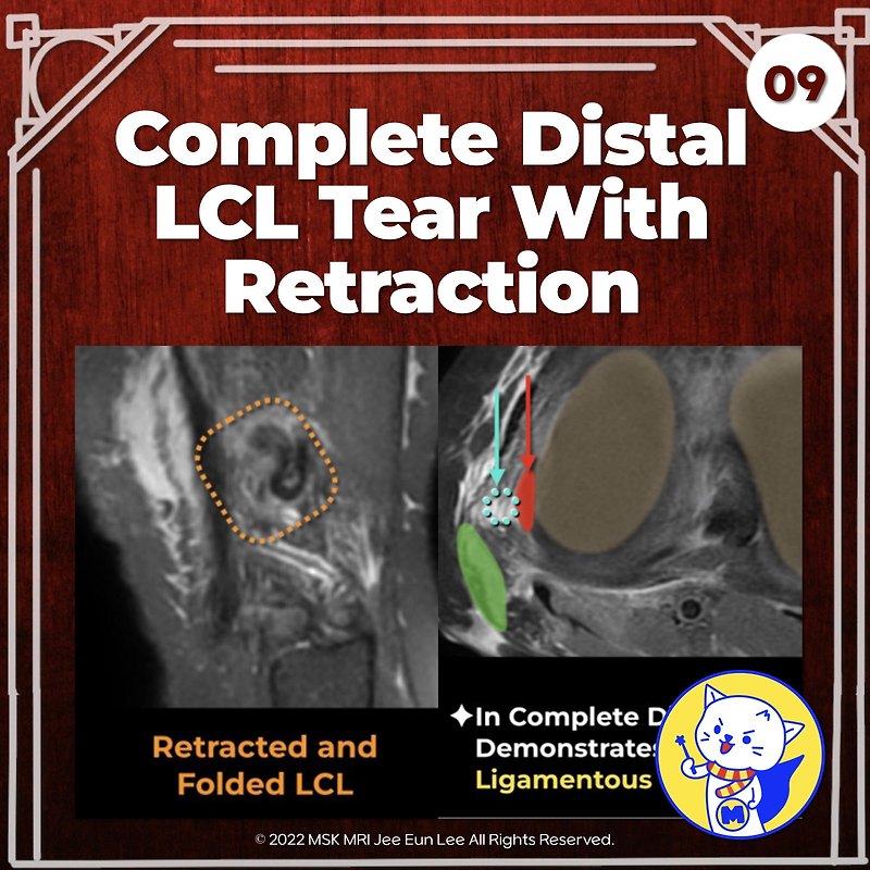 (Fig 3-B.09) Complete Distal LCL Tear with Retraction