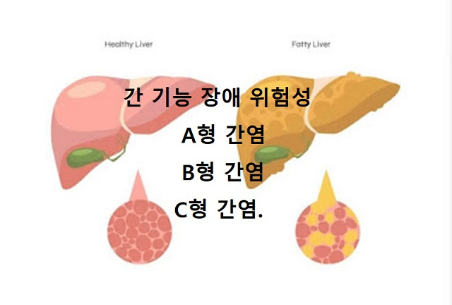 간 기능 장애 위험성.간염. A형 간염. B형 간염.C형 간염.