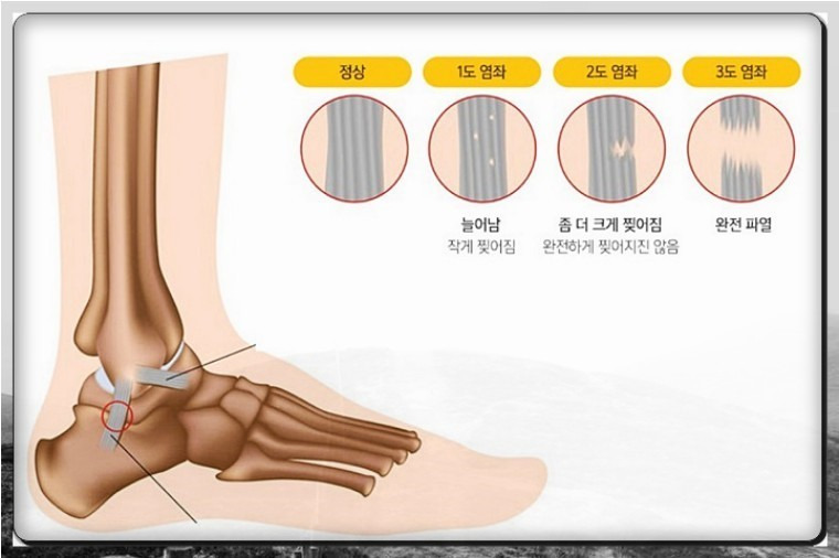 인대 파열 수술 꼭 해야 하나요?