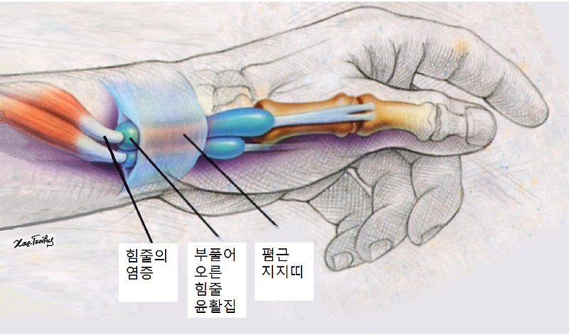 닥터 배의 의학정보★ :: 손목의 통증 (1) : 드퀘르벵 증후군 (손목건초염)