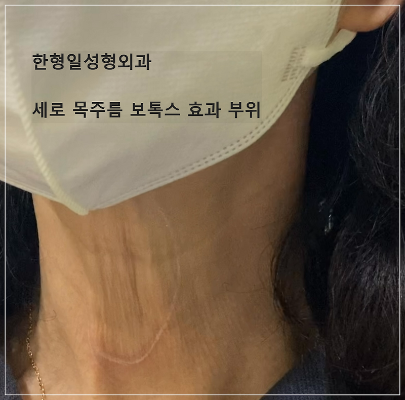 세로 목주름 보톡스 효과 부위