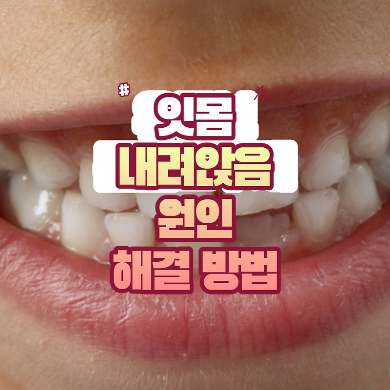 잇몸 내려앉음 원인 및 자연 치유 방법