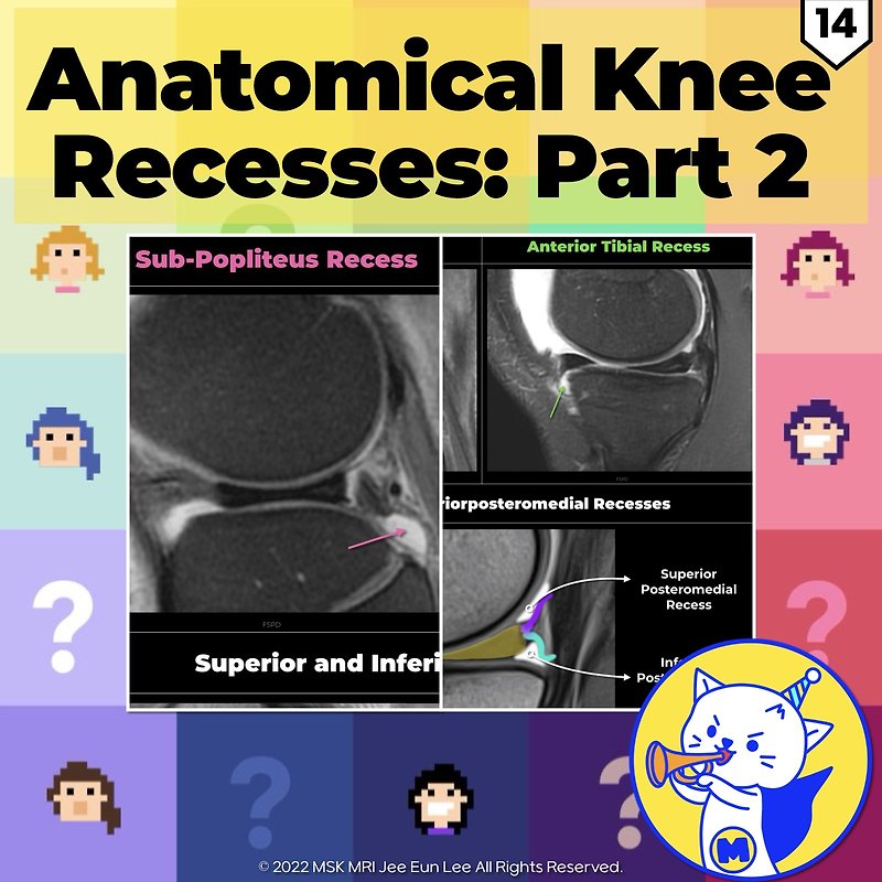 (fig 4-d.14) Anatomical Knee Recesses: Part 2