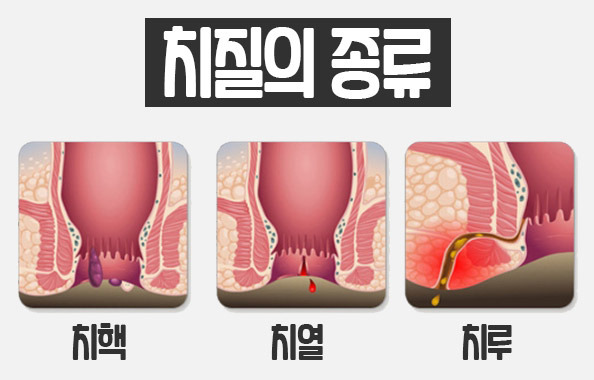 치질 원인 파악 및 치핵 자연치료 후기 확인하기