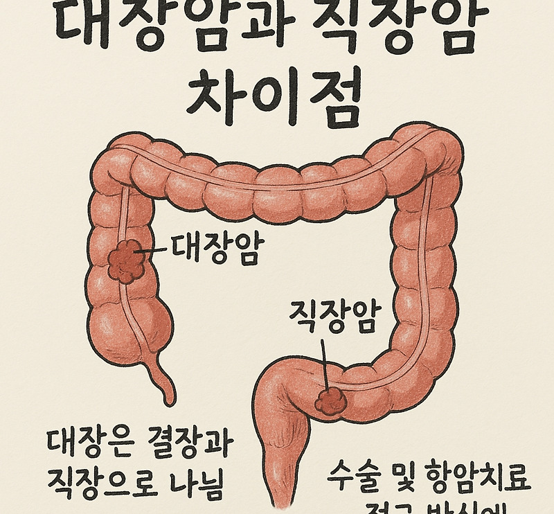 대장암과 직장암 차이점 꼭알아야할 핵심구분