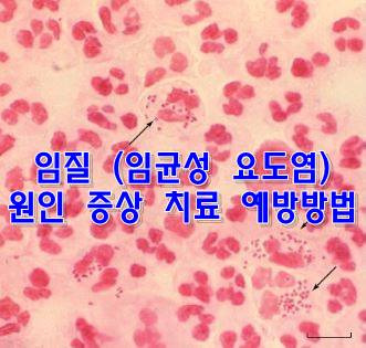 임질 ( 임균성 요도염) 원인 증상 치료 예방방법