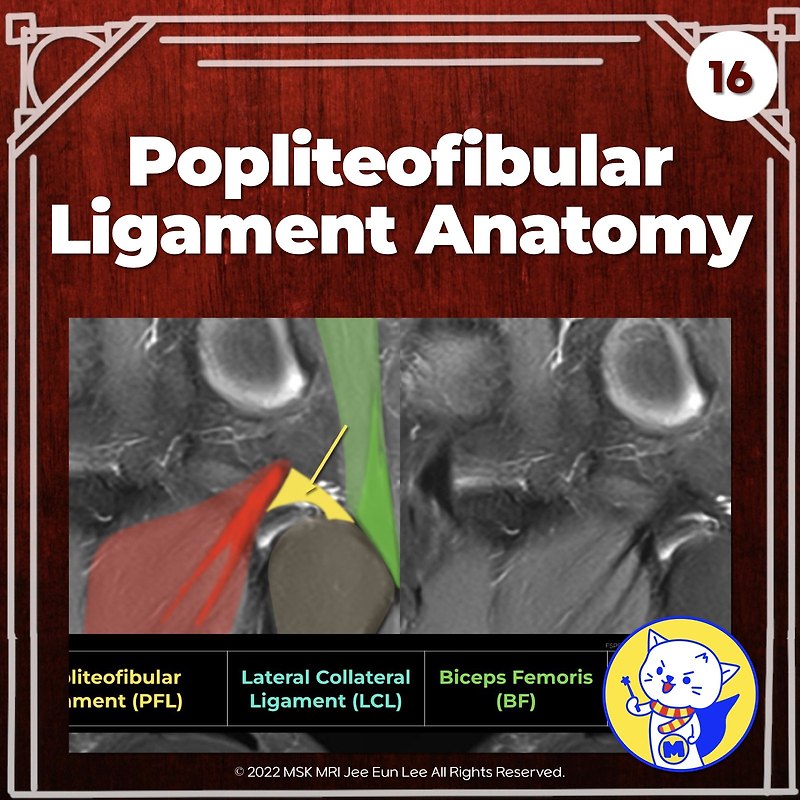 (Fig 3-B.22) Arcuate and Fabellofibular Ligament Tears