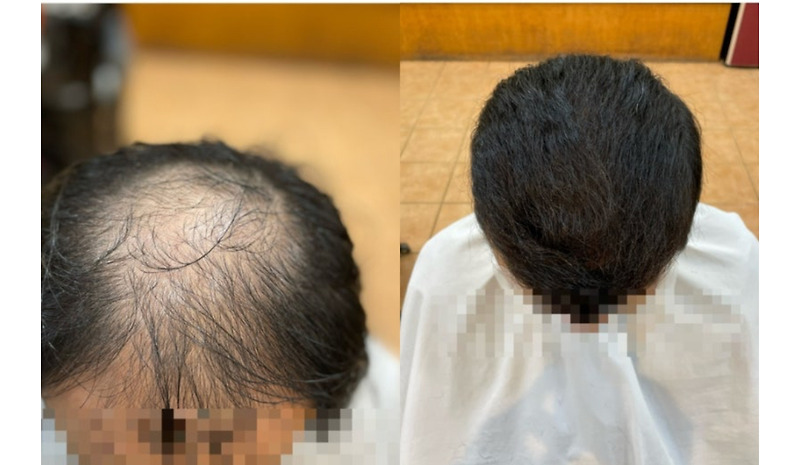 대머리남자탈모 리얼대변신 부산사상구추천미용실 머리잘하는탈모커버펌헤어스타일르네시떼헤어숍탈모컷에서펌염색복구클리닉두피케어탈모케어원스톱 원탑관리