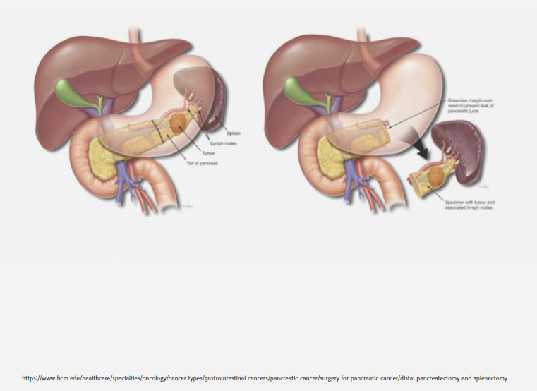 원위부 췌장 절제술과 비장적출술이란? (Distal Pancreatectomy and Splenectomy)