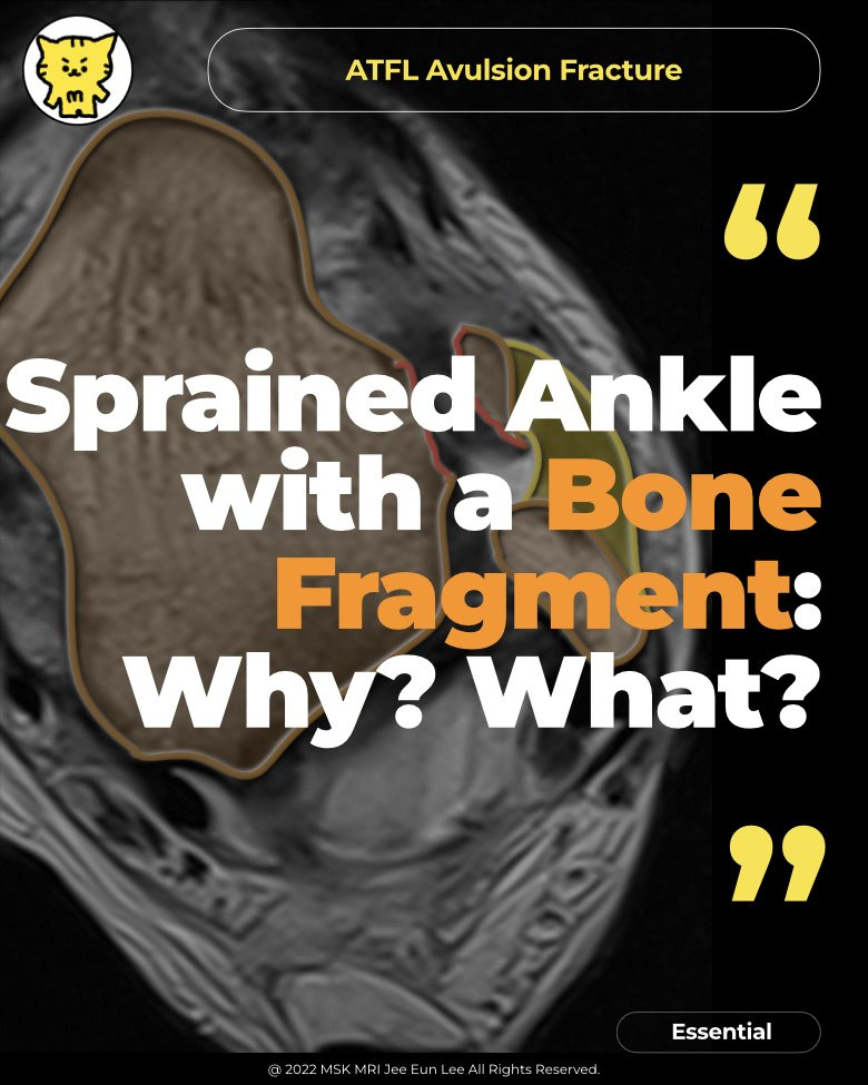 essential-sprained-ankle-with-a-bone-fragment-why-what