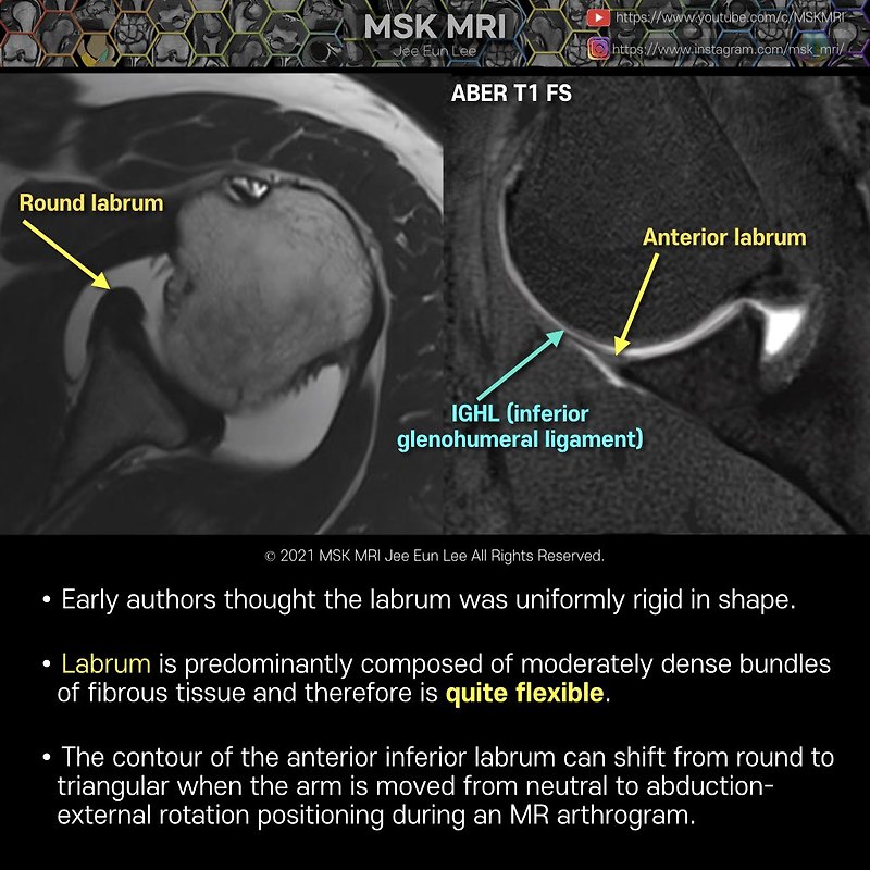 [ Anatomy Labrum] #01 Glenoid labrum shape, flexible labrum ...