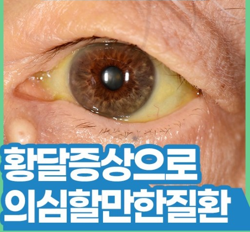 심한 복통, 황달