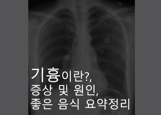기흉이란?, 증상 및 원인, 좋은 음식 요약정리 :: everything~