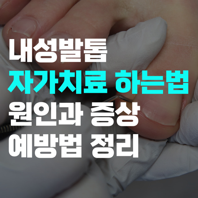 내성발톱 자가치료 원인 증상 예방 방법 - 인포씨