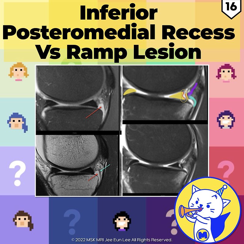 (Fig 4-D.16) Inferior Posteromedial Recess vs. Ramp Lesion