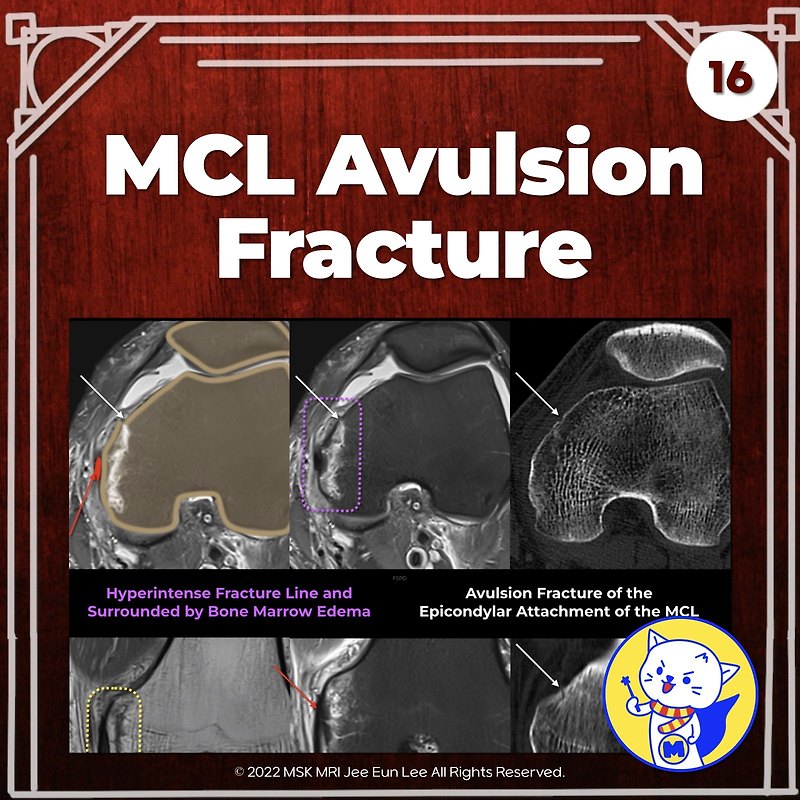 (Fig 3-A.16) MCL Avulsion fracture