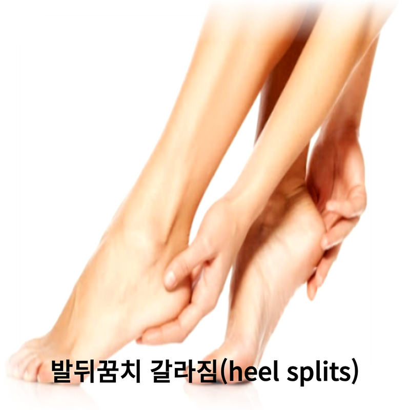 당뇨 환자를 위한 발 건강 관리, 발뒤꿈치 갈라짐 당뇨