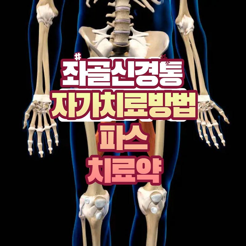 좌골신경통 자가치료 방법 및 파스, 치료약
