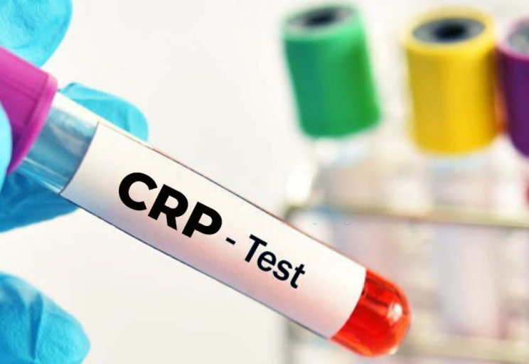 CRP 정상수치 및 관리법, 원인 5가지