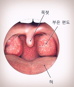 편도 부었을 때 가라앉히는 방법, 원인과 치료