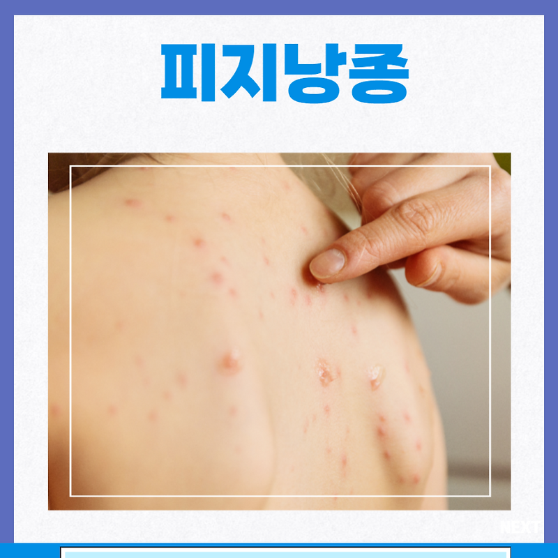 표피낭종 액와피지낭종(얼굴, 귓불, 귀, 두피 등)의 원인 및 절제