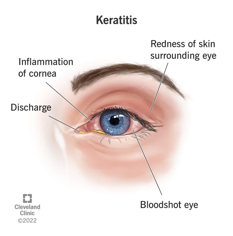 Understanding Keratitis: Causes, Symptoms, and Treatment