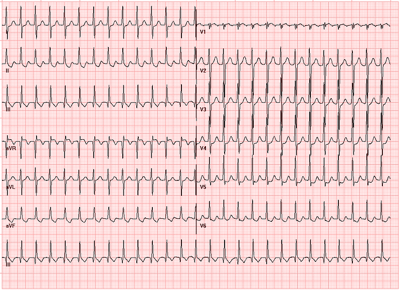 Psvt Ecg / Dr. Smith's ECG Blog: Paroxysmal SVT (PSVT) that ...