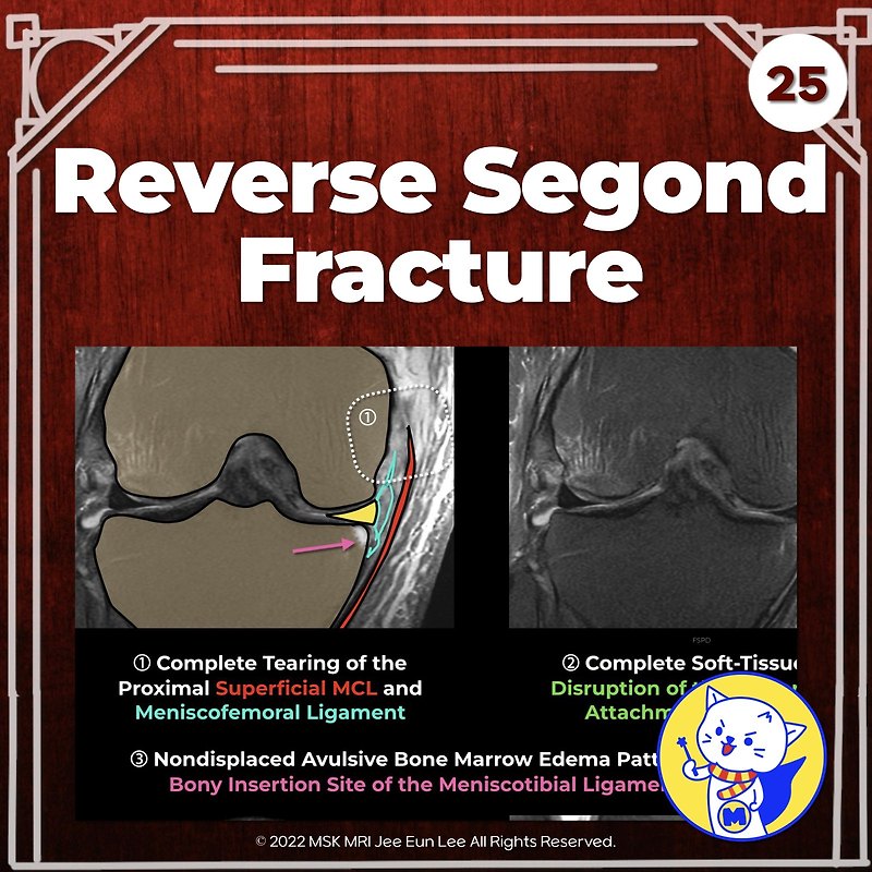 (Fig 3-A.25) Reverse Segond Fracture