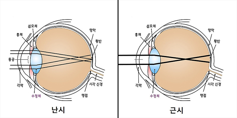 난시 근시 차이? 난시의 원인과 증상은? - 오늘의엔딩