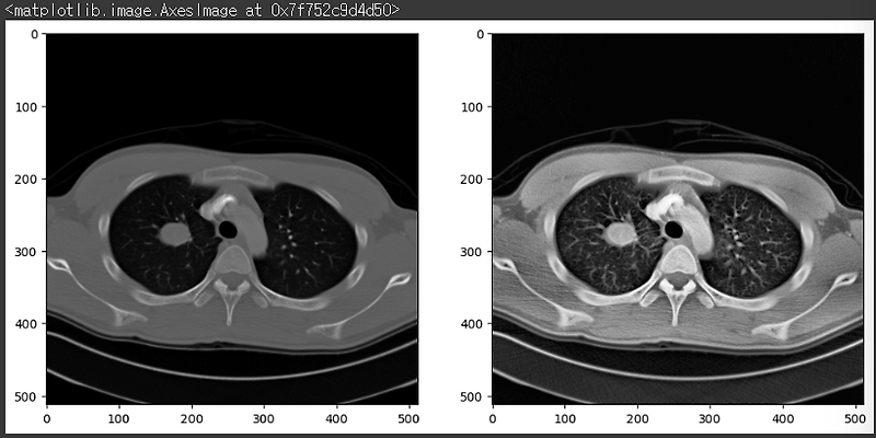 의료 영상 데이터 전처리 방법 - Resize, Resample, Normalization, Gamma Correction ...
